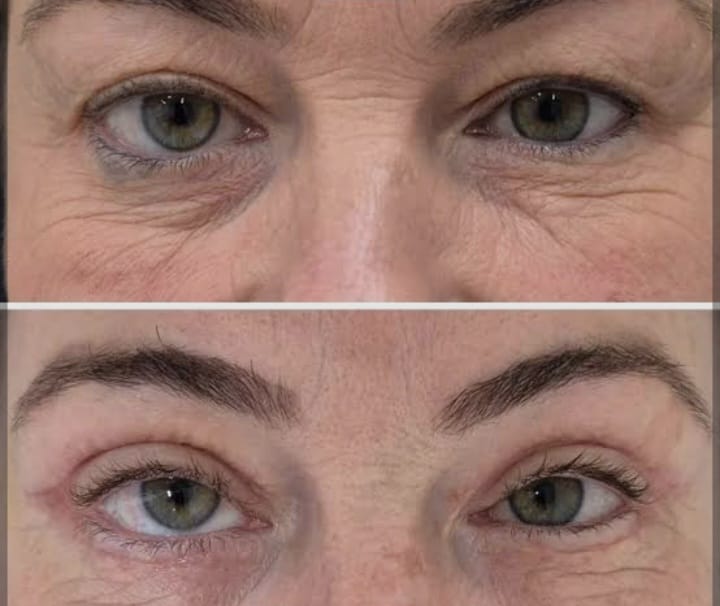 Blefaroplastia