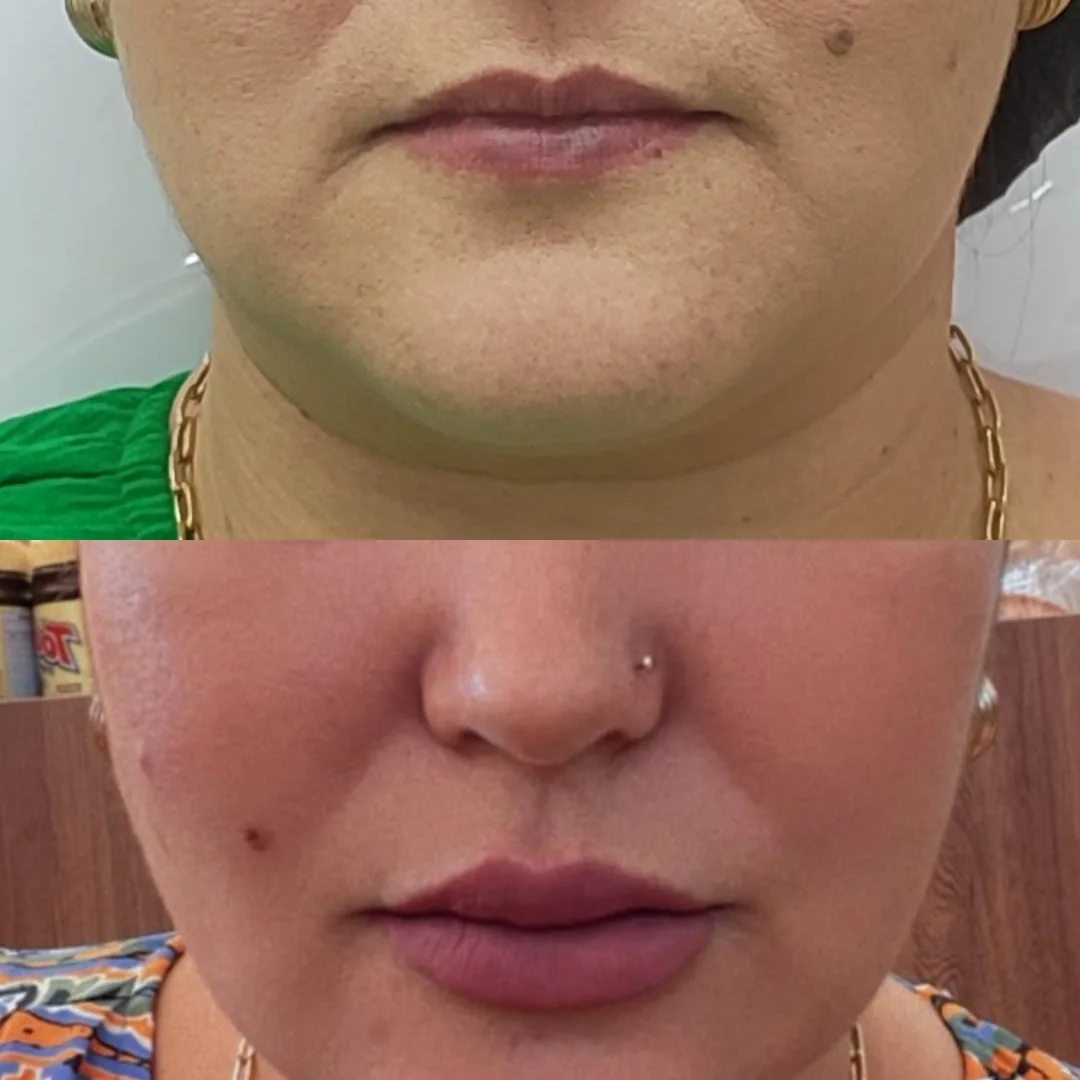 Preenchimento com Ácido Hialurônico